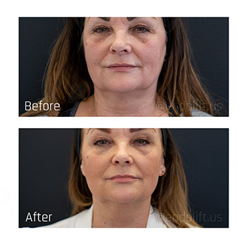 cheryl-full-face-endolift