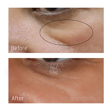 daniel-ezra-malar-bags-endolift