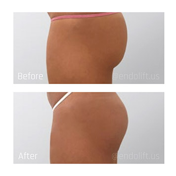 gluteus-endolift