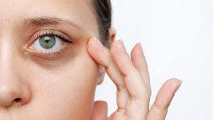 How To Remove Dark Circles Under Eyes Permanently