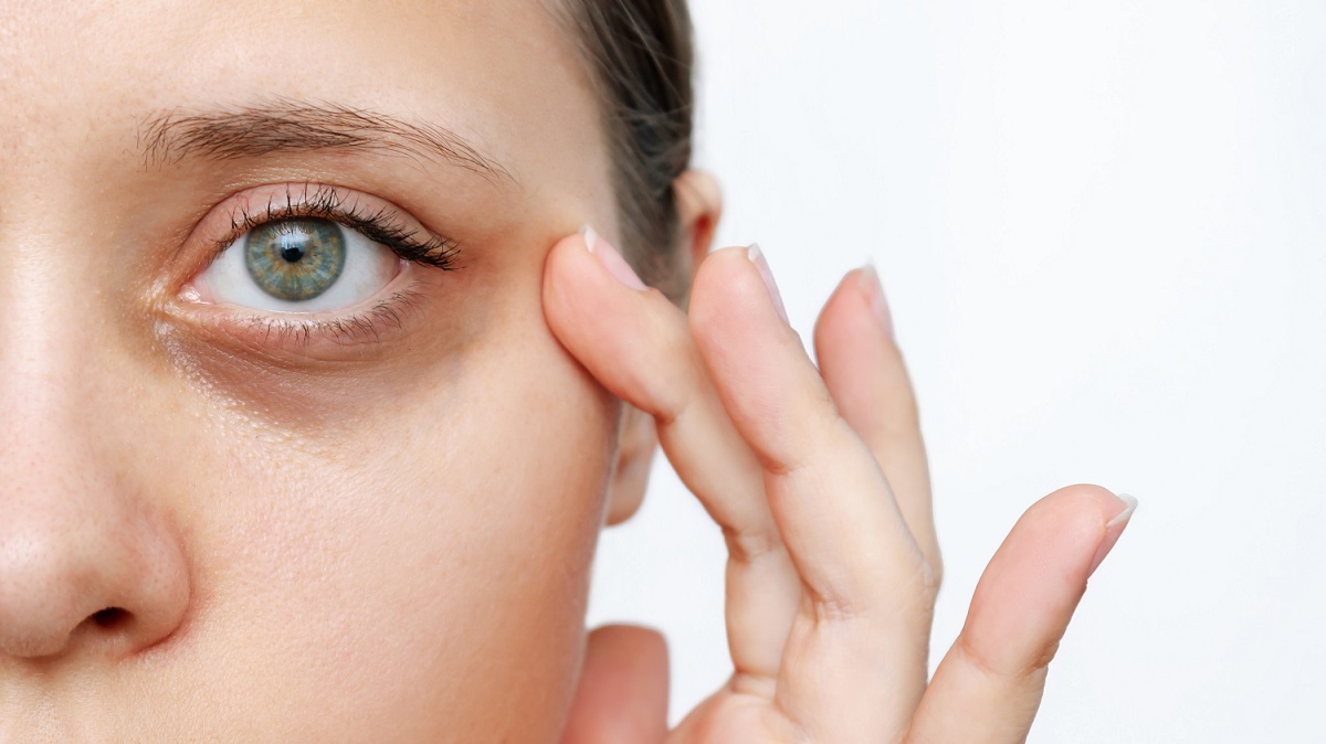 How To Remove Dark Circles Under Eyes Permanently
