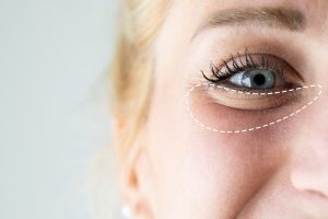 Under eye bags highlighted as a common concern treated with eyelid surgery