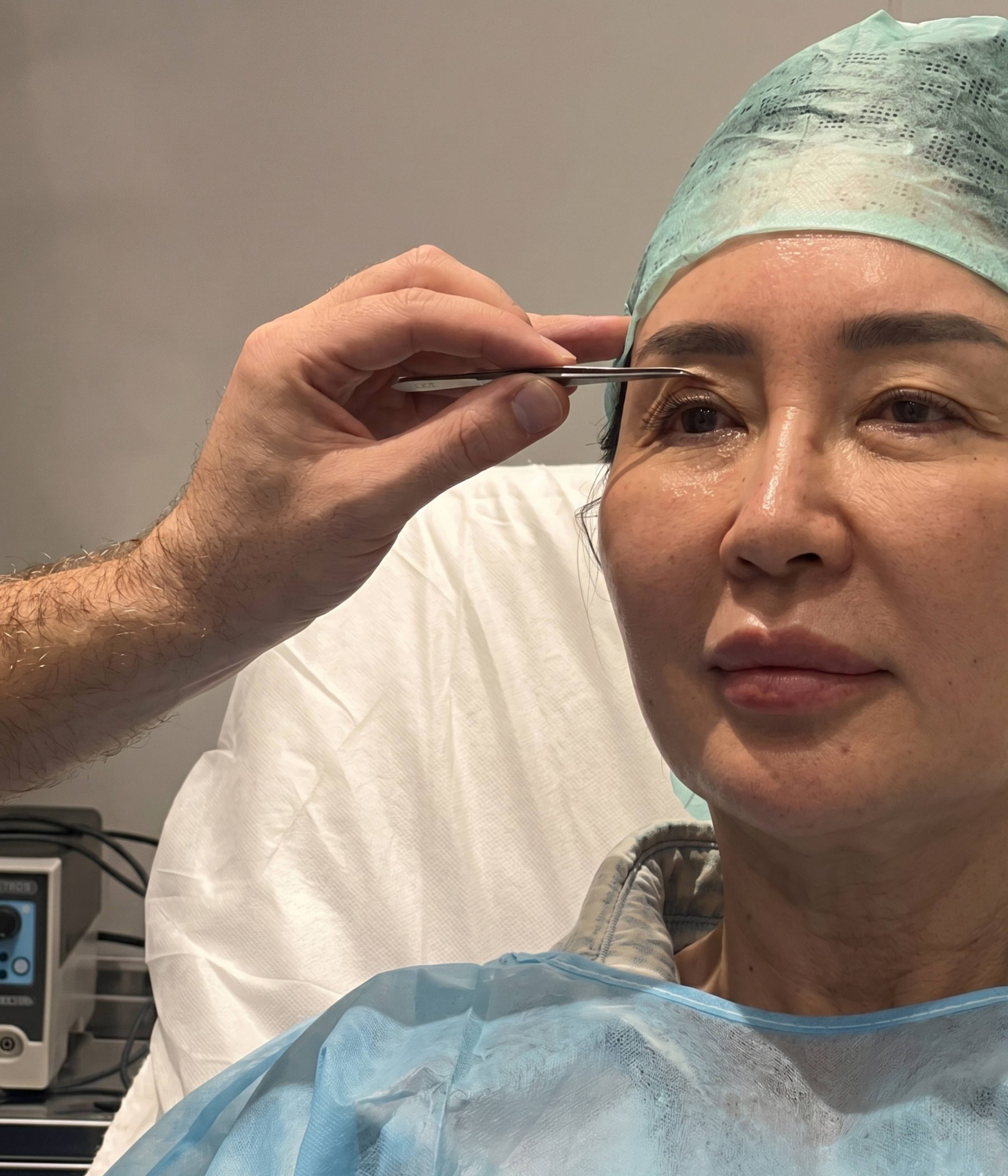 Upper Blepharoplasty London — Dr Tanov
