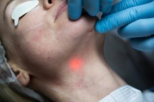 Endolift Side effects