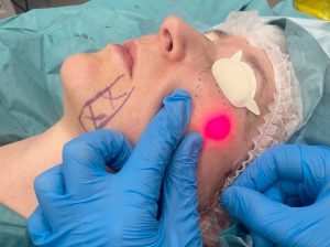 How Long does endolift last