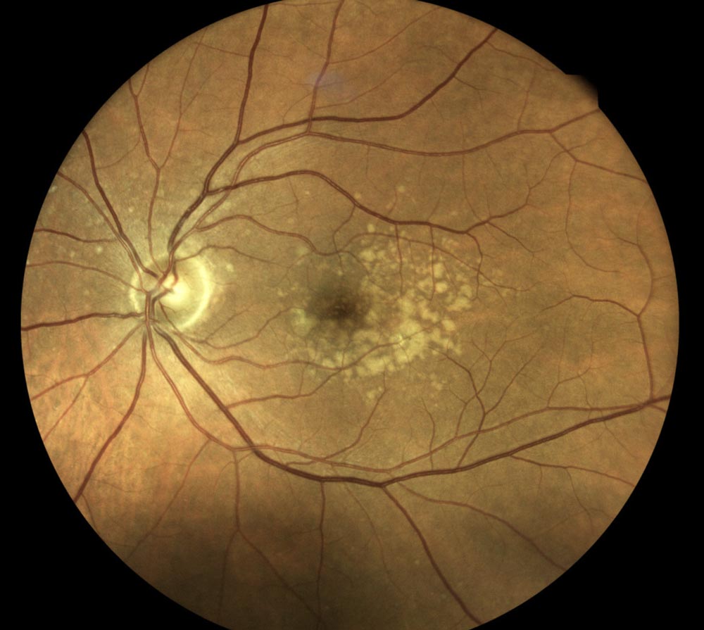 Macular Degeneration