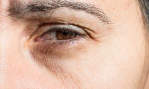 How to Get Rid of Under Eye Wrinkles