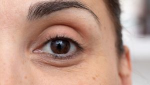 Types of Dark Circles