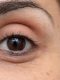 Types of Dark Circles
