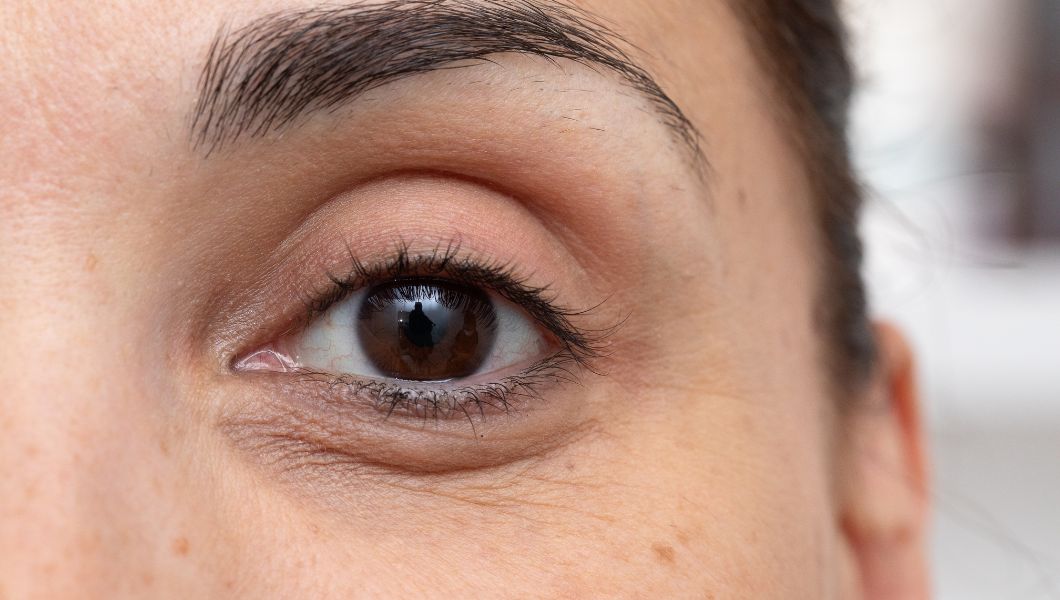 Types of Dark Circles