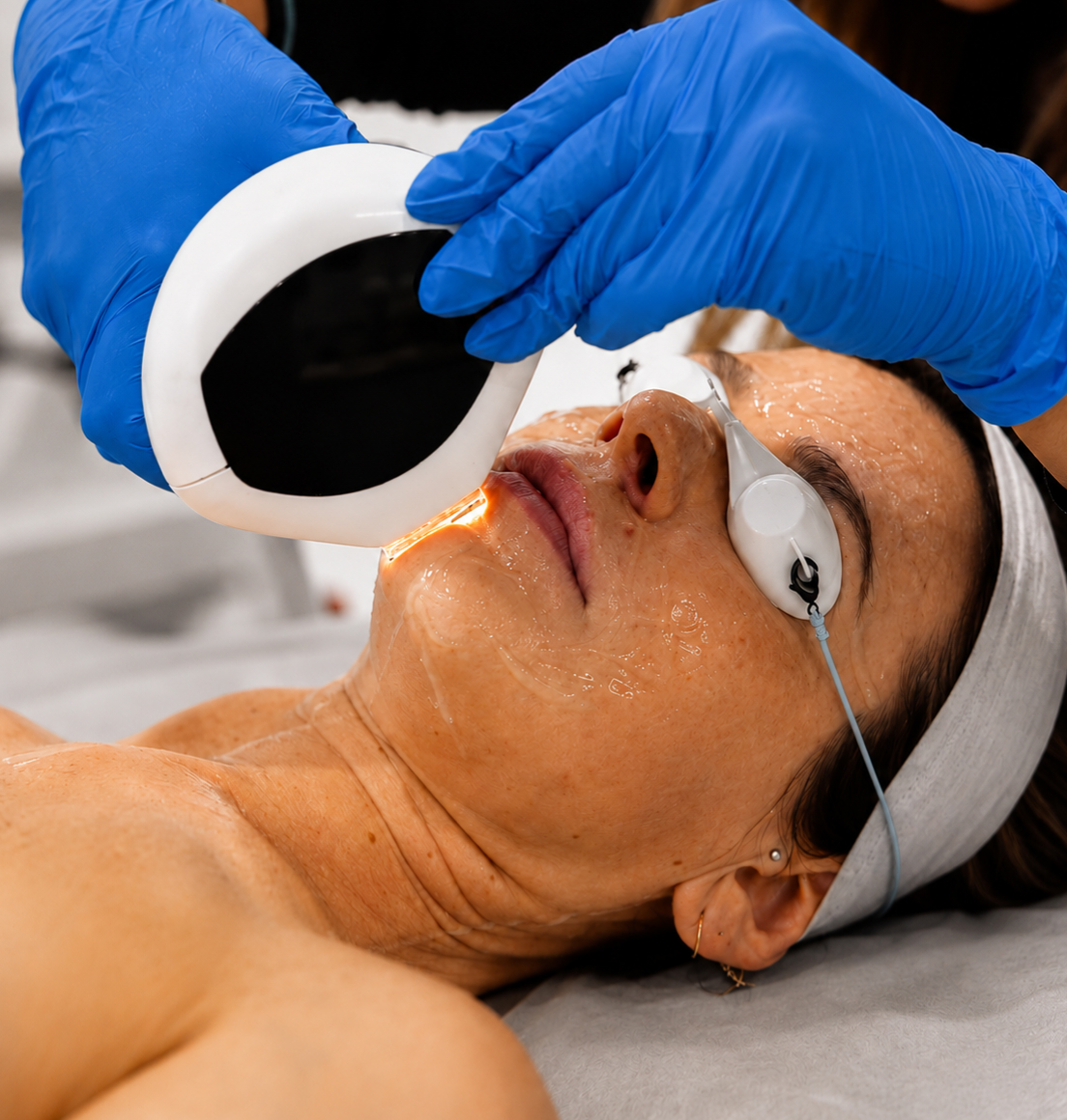 IPL Photofacial for Pigmentation and Sun Damage in Newcastle — Dr Tanov
