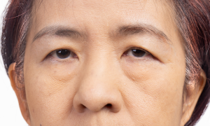 How to Fix a Droopy Eyelid Without Surgery