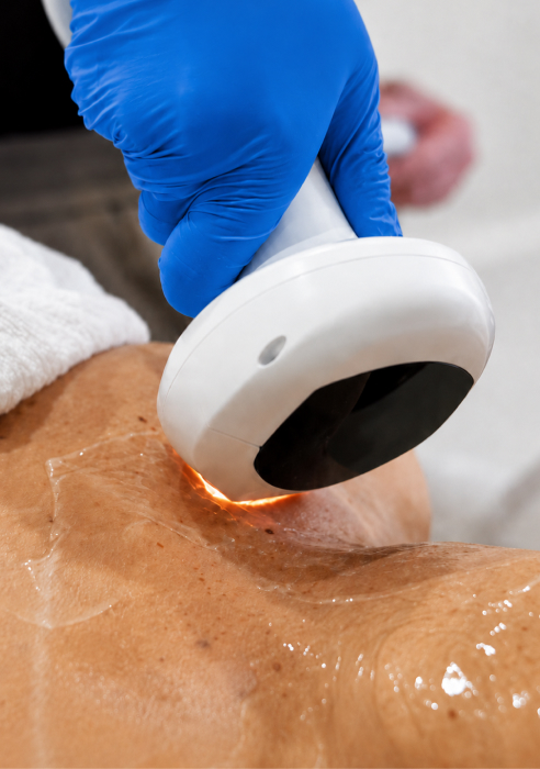 IPL Photofacial treatment in Newcastle