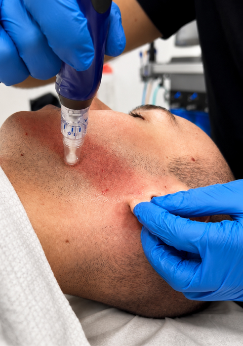 What is SkinPen microneedling