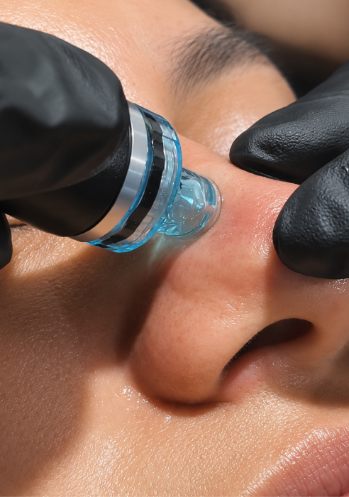 HydraFacial treatment in Newcastle