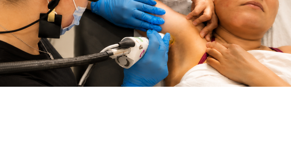 Laser Hair Removal