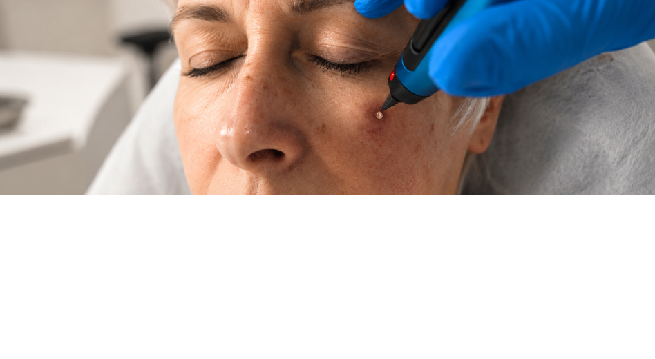 Skin Lesion