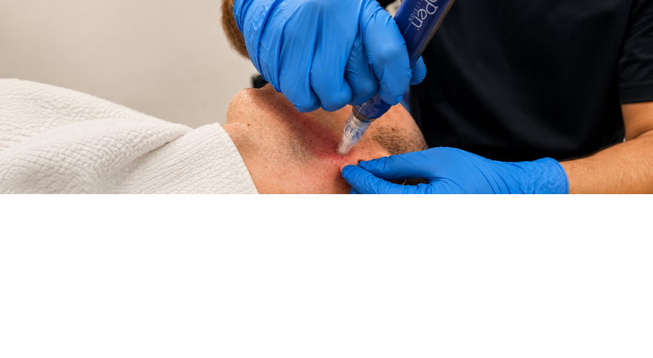 SkinPen