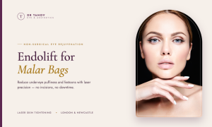 Endolift for Malar Bags