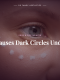 What Causes Dark Circles Under Eyes