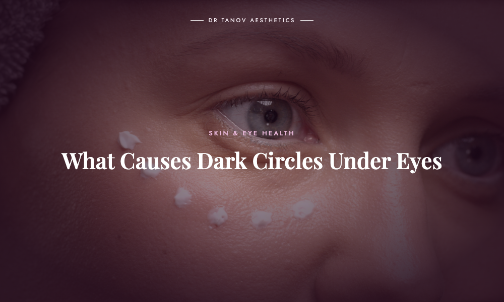 What Causes Dark Circles Under Eyes