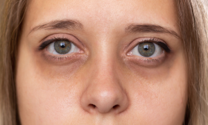 What Causes Dark Circles Under Eyes