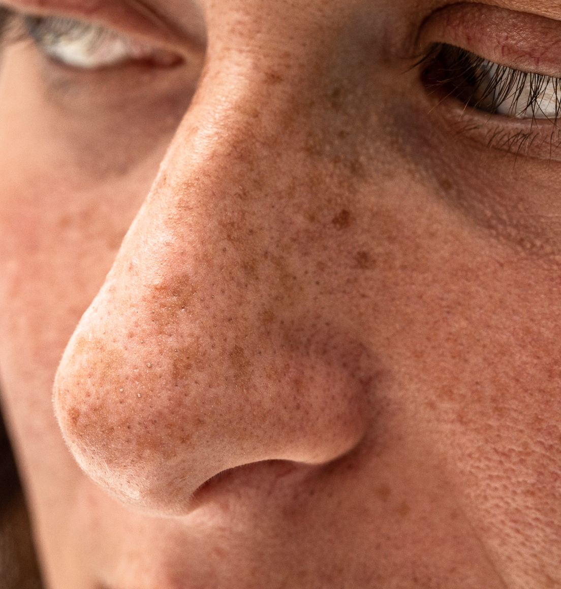 Age and Sun Spot Removal Newcastle — Dr Tanov