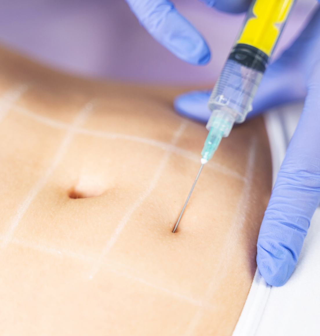 Body Shaping and Fat Dissolving Injections in Newcastle — Dr Tanov
