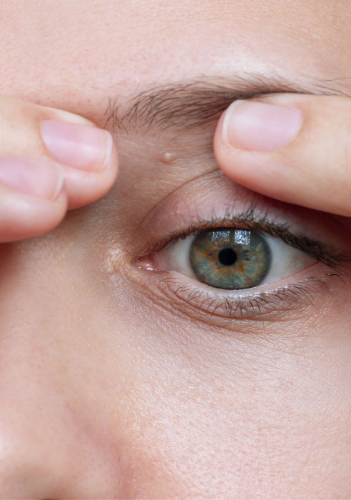What is milia treatment