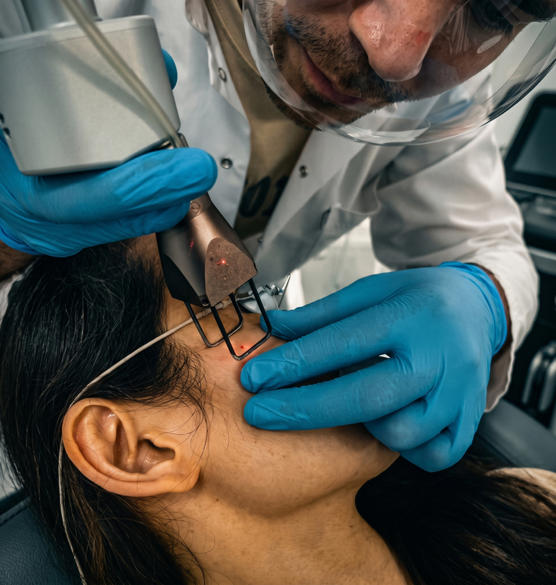 Mole Removal with CO2 Laser in London — Dr Tanov