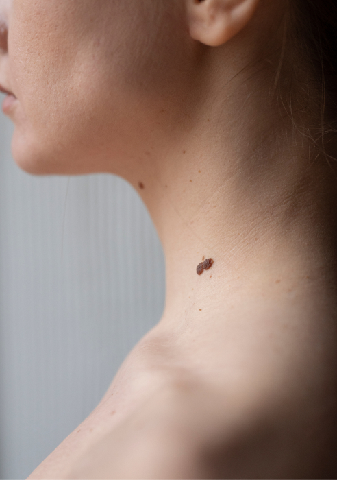 Mole removal with CO2 laser in London