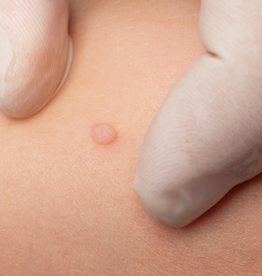 Molluscum Contagiosum Removal Newcastle — Dr Tanov