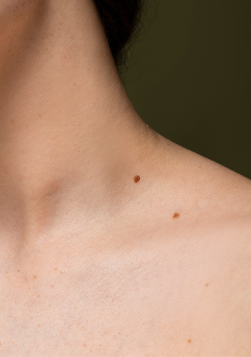 Mole removal with CO2 laser in Newcastle