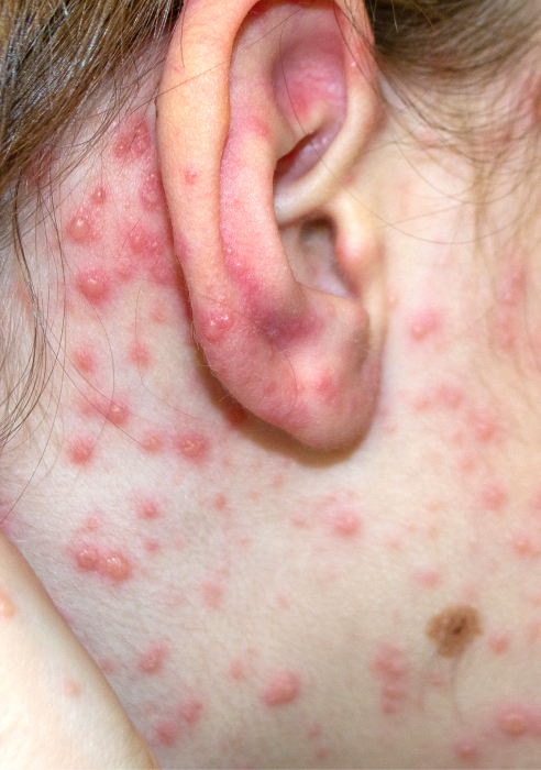 What is molluscum contagiosum treatment