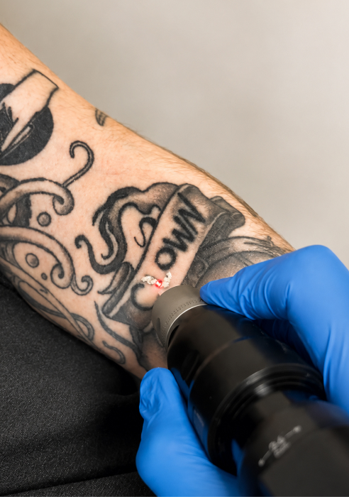 PicoSure Pro laser tattoo removal procedure