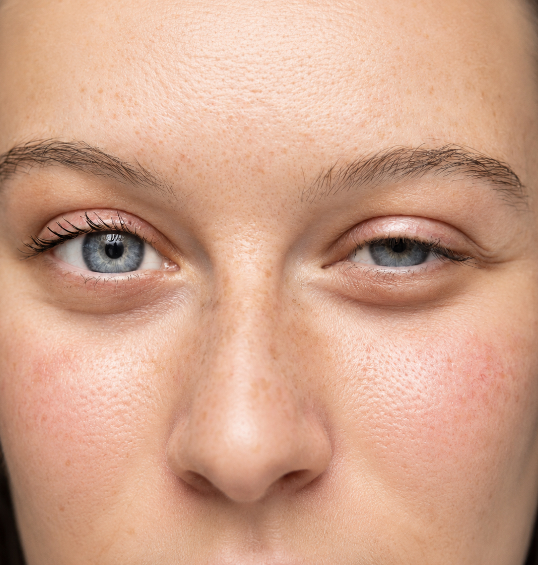 Ptosis Surgery in London, Dr Tanov Aesthetics