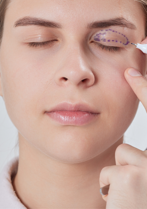 Ptosis surgery eye marking before procedure