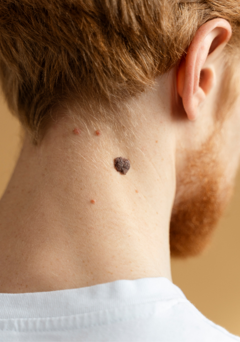 Seborrheic keratosis removal treatment in Newcastle