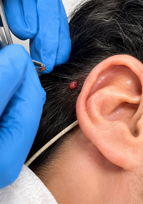 What is skin lesion removal