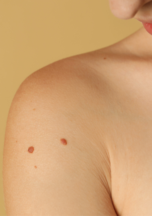 Skin tag removal treatment in Newcastle