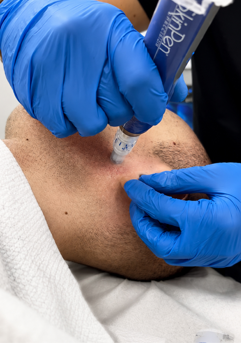 What is skinpen microneedling