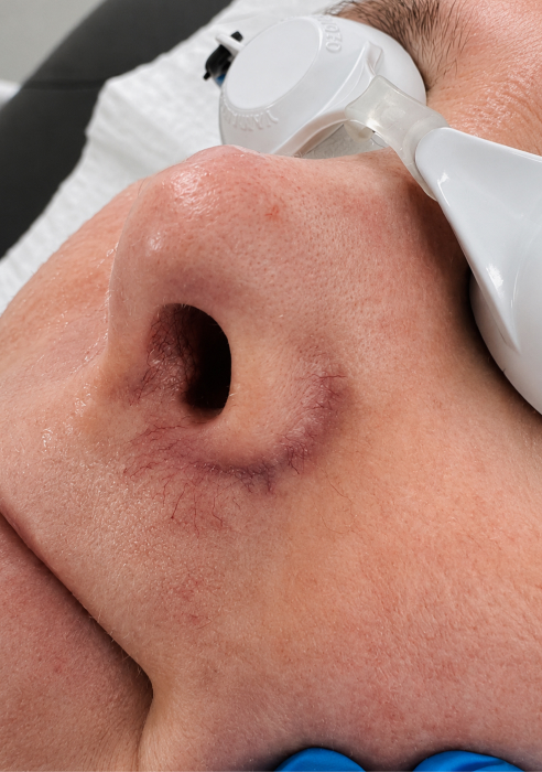 What are thread veins and facial redness