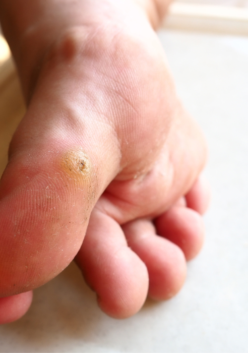 Wart and verruca removal treatment in Newcastle