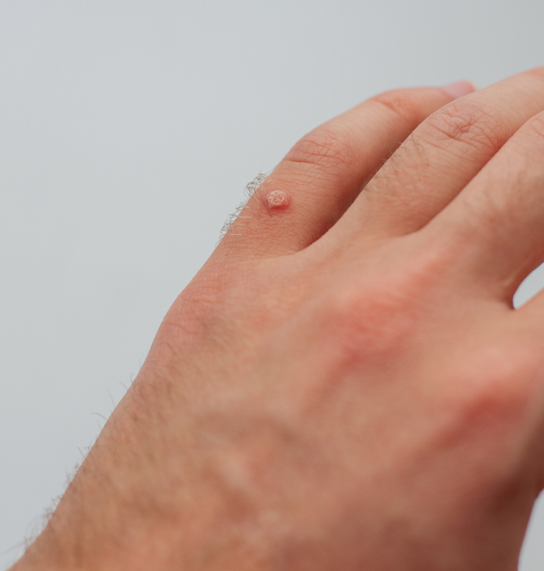 Wart and Verruca Removal in Newcastle — Dr Tanov