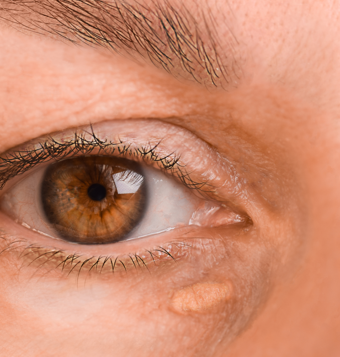 Xanthelasma Removal Newcastle — Dr Tanov