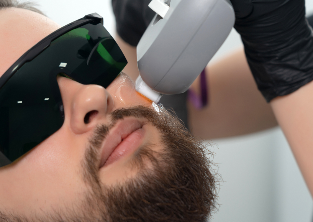 Laser hair removal for beard lines and shaving rash