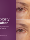Upper Blepharoplasty Before and After