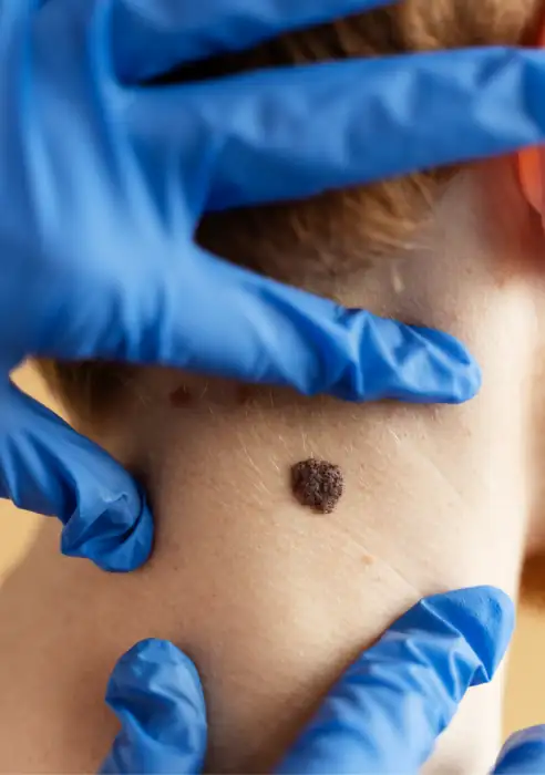 Seborrhoeic keratosis removal treatment in London