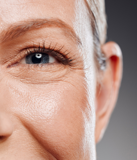 Crow's feet treatment — Dr Tanov