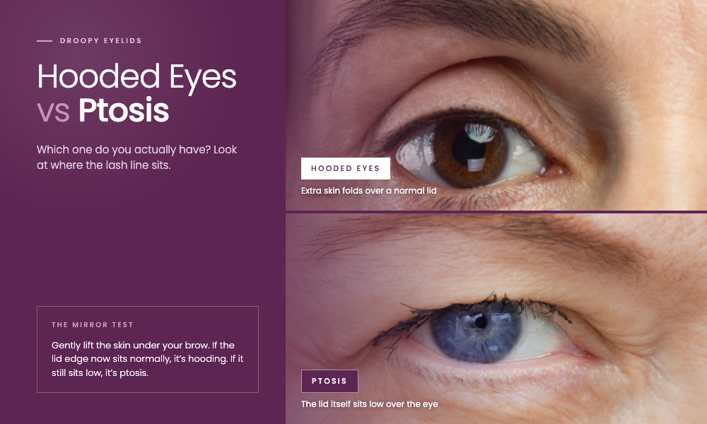 Hooded Eyes vs Ptosis